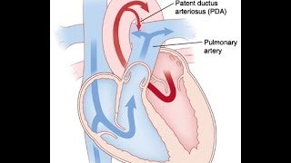 Patent Ductus Arteriosus [upl. by Anitel]