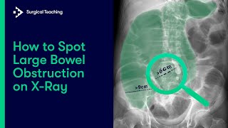 Large Bowel Obstruction  How do we Diagnose it on Abdominal XRay [upl. by Minne453]