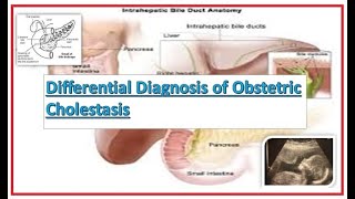 Differential Diagnosis of Obstetric Cholestasis in Pregnancy [upl. by Ahcatan886]