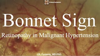 Bonnet Sign Retinopathy in Malignant Hypertension [upl. by Seen]