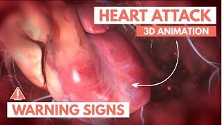 Recognizing a heart attack  3D Animation [upl. by Rikki]