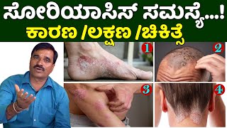 Psoriasis Treatment in Karnataka  Soriyas Disease Treatment Kannada  Nati Vaidya Neelakantha [upl. by Micaela590]