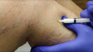 Sclerotherapy Varicose Veins Treatment [upl. by Kavanagh]