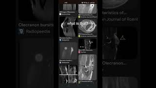 olecranon bursitis msk radiology gout cpp [upl. by Serrano]