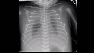 whats the most common cause of pleural effusion in neonates chylothoraxlymphatic thoracic leakage [upl. by Ggerc]