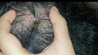 best patch of dandruff scab found so far  satisfying  watch till end  scab pick using knife asmr [upl. by Suivat963]