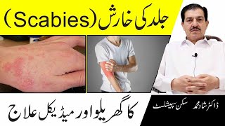 How To Treat Scabies Naturally At Home In Urdu [upl. by Yunick]