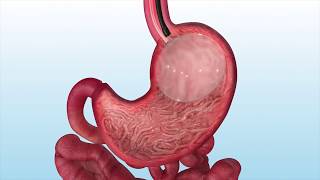 How the ORBERA™ gastric balloon is placed in the stomach [upl. by Beryl]