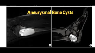 Aneurysmal Bone Cyst [upl. by Eniala]