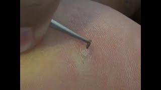 Splinter Removal  Splinter remove from leg [upl. by Ladin493]