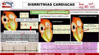 Qx cardiologia  ARRITMIAS AUTOMATISMO [upl. by Oiril304]