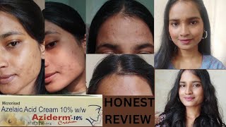 Azelaic Acid Cream 10  Aziderm Cream  Honest Review  Remove Pigmentation  Acne  Dark Sports [upl. by Tihw]