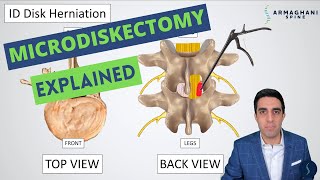 Microdiskectomy Anatomy Step by Step Procedure Risks Recovery and Restrictions [upl. by Cele]