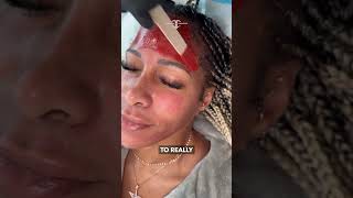 Fabulous Shereé Whitfield gets her second MelanX Chemical Peel 💥 The Real Housewives of Atlanta st [upl. by Aryc934]