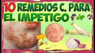 10 Remedios Caseros Para El Impetigo  Como Curar el Impetigo [upl. by Hesler843]