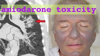 amiodarone toxicity [upl. by Aeslehc343]