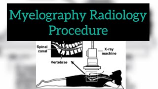 Myelogram procedure  Radiology Procedure  Radiographer  lumbar puncture  ct  xray real images [upl. by Indys]