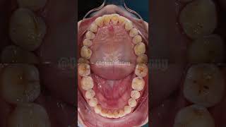 Underbite braces transformation braces orthodontist dentist bracket drcong globaldental expat [upl. by Jagir]