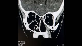 Recurrence of juvenile angiofibroma [upl. by Simone]