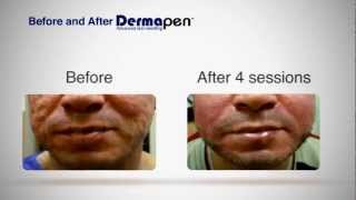 MicroNeedling Before and After  Dermapen® Treatment [upl. by Verger]