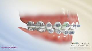 Elastics  Class II Triangle 3 to 45  Orthodontic Treatment [upl. by Anahsat]