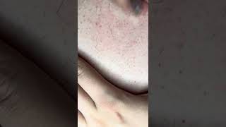 Ingrown hairs part 3 [upl. by Montagu235]