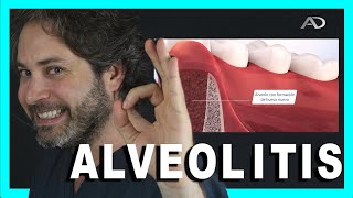 🌡️ALVEOLITIS SECA CAUSAS Y SOLUCIONES🥵Infeccion después de SACAR una MUELA [upl. by Asiole400]