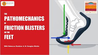 The Pathomechanics of Friction Blisters on the Feet  Blister Prevention [upl. by Nala998]