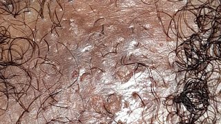 ingrownhairremoval ingrownhair blackhead removal  infected ingrown hair removal viral asmr [upl. by Ardnuasal302]