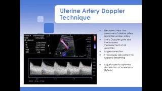 Advanced Fetal Doppler Webinar with Piotr Niznik [upl. by Einnim]