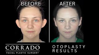 Otoplasty Surgery with Before amp After Photos  Dr Anthony Corrado [upl. by Werbel583]