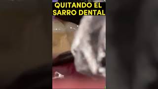 ELIMINANDO SARRO DENTAL CON ULTRASONIDO BOCA MUY SUCIA [upl. by Inail]