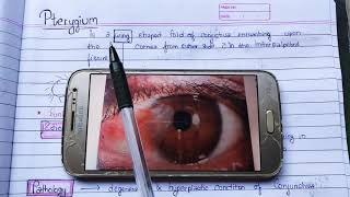 Pterygium theory exam notes AK Khurana [upl. by Odareg]