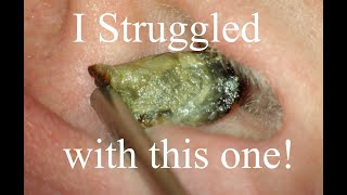 I struggled with this one Deep Impaction small canal Ear wax removal [upl. by Blankenship]