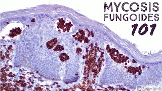 Mycosis Fungoides 101 Cutaneous Tcell Lymphoma CTCL for Dermatopathology Pathology Dermatology [upl. by Leinahtam994]