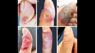 Ecthyma contagiosum durch Schafpockenvirus Orf [upl. by Pedersen5]