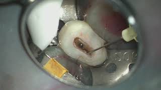 Endodontic Retreatment with the XP3D Instrumentation [upl. by Jason]