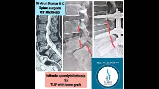 listhesis outcome [upl. by Yesnek]