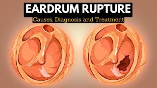 The Science Behind Eardrum Rupture Explained in Simple Terms [upl. by Jerrome]