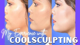 My Experience with CoolSculpting  QampA and Results [upl. by Melone283]