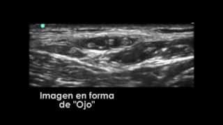 BLOQUEO DEL NERVIO LATERAL CUTÁNEO FEMORAL MEDIANTE ECOGRAFÍA [upl. by Aerdnahc]