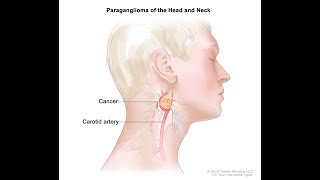 paraganglioma and d d [upl. by Riccio]