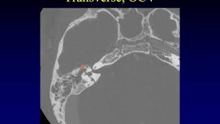 Temporal Bone Pathology 10 Trauma [upl. by Ahsiliw]