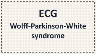 WPW syndrome  ECG  Wolff Parkinson White Syndrome ECG changes simplified  Delta Wave [upl. by Annaehr]