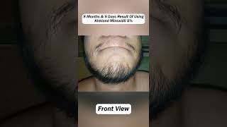 8 MONTH  Beard Journey Update [upl. by Ayel]