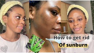 How to get rid of SUNBURN fast on the face simply and effective natural home remedy [upl. by Itaws]