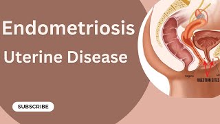 Endometriosis  Diseases of Uterus Gynaecology Lecture  Part 12 [upl. by Hessler]