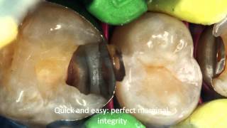 Clinical Case 2  Class II Restorations by Dr Alexander Fetsych [upl. by Berget]