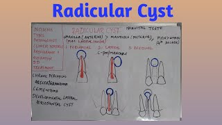 Radicular cyst [upl. by Fairweather676]