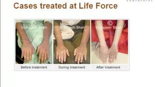 What is Lichen Planus Presentation By Experts at Life Force [upl. by Eveivaneg]